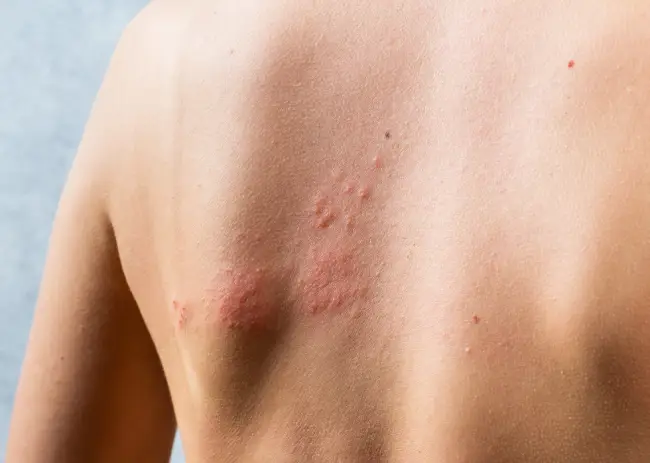 Histamine Intolerance_How It Works and What You Can Do About It