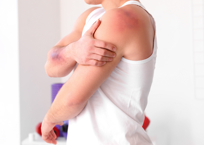4 Signs You Should Get Unexplained Bruising Investigated